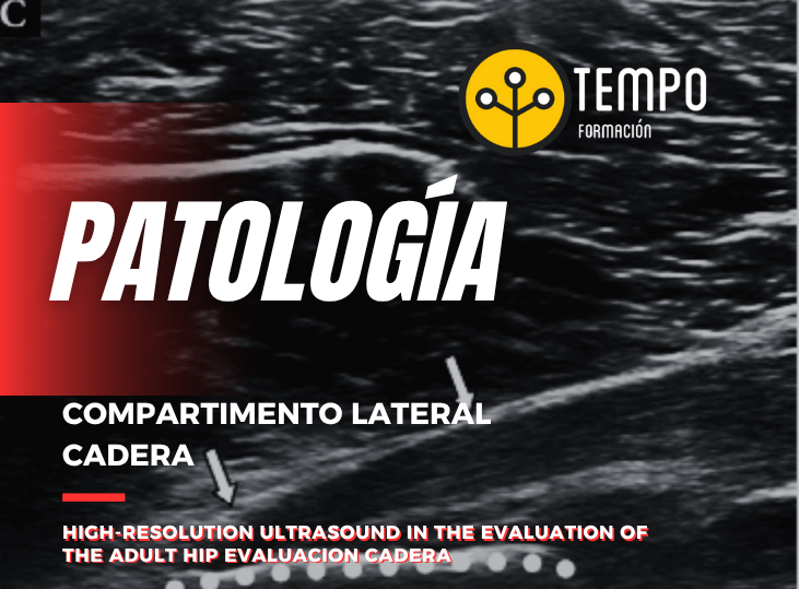 patologia-compartimento-lateral-de-la-cadera